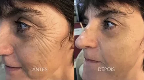 Antes x Depois.12webp