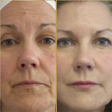 Antes x Depois.3webp