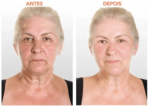 Antes x Depois.7webp