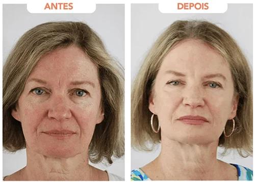 Antes x Depois.8webp