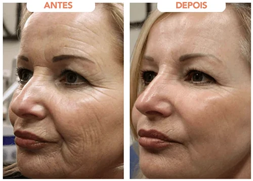 Antes x Depois